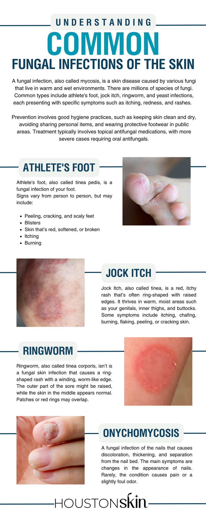 Fungal infection Infographic website