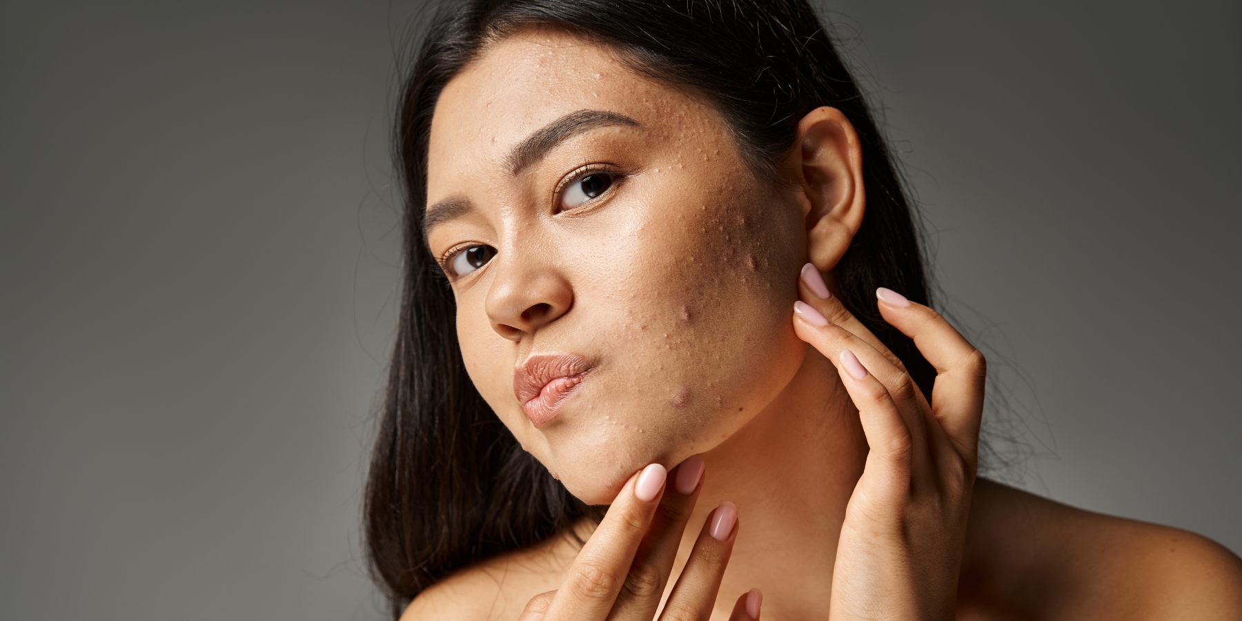 HoustonSkin Internal Acne Treat