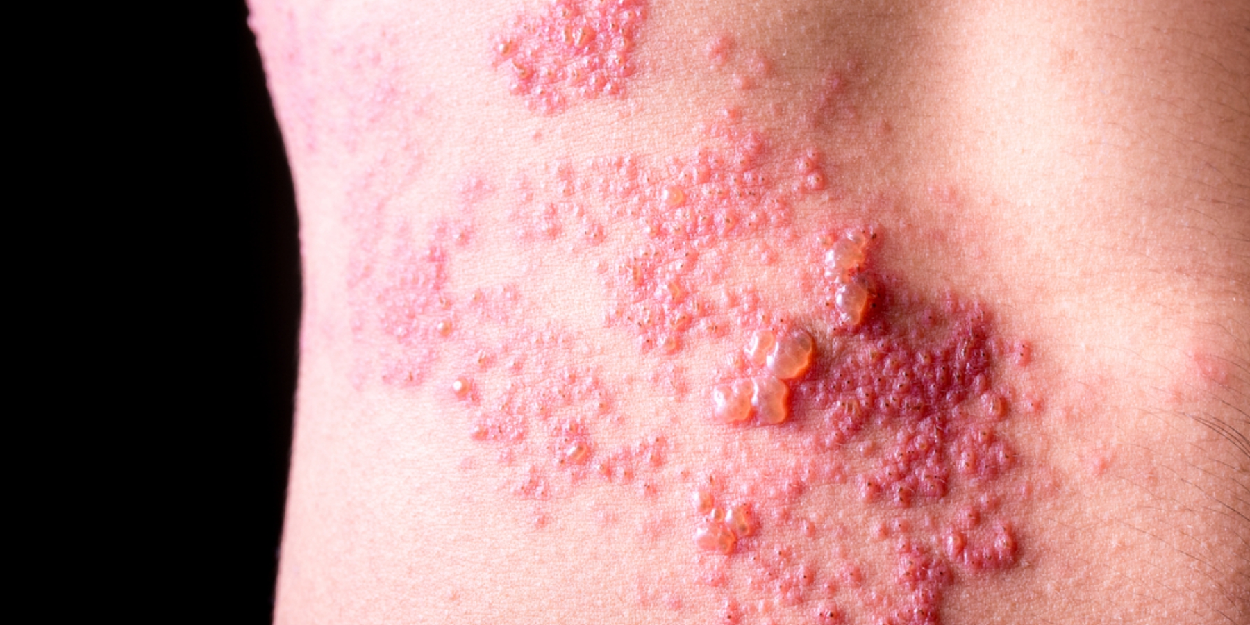 HoustonSkin Internal Shingles