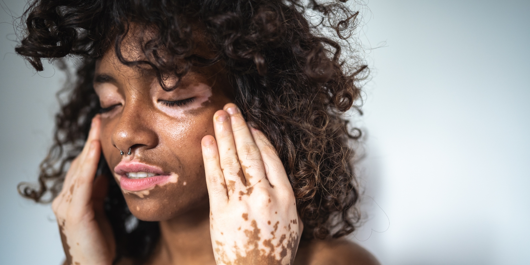 HoustonSkin Internal Vitiligo